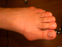 hallux valgus