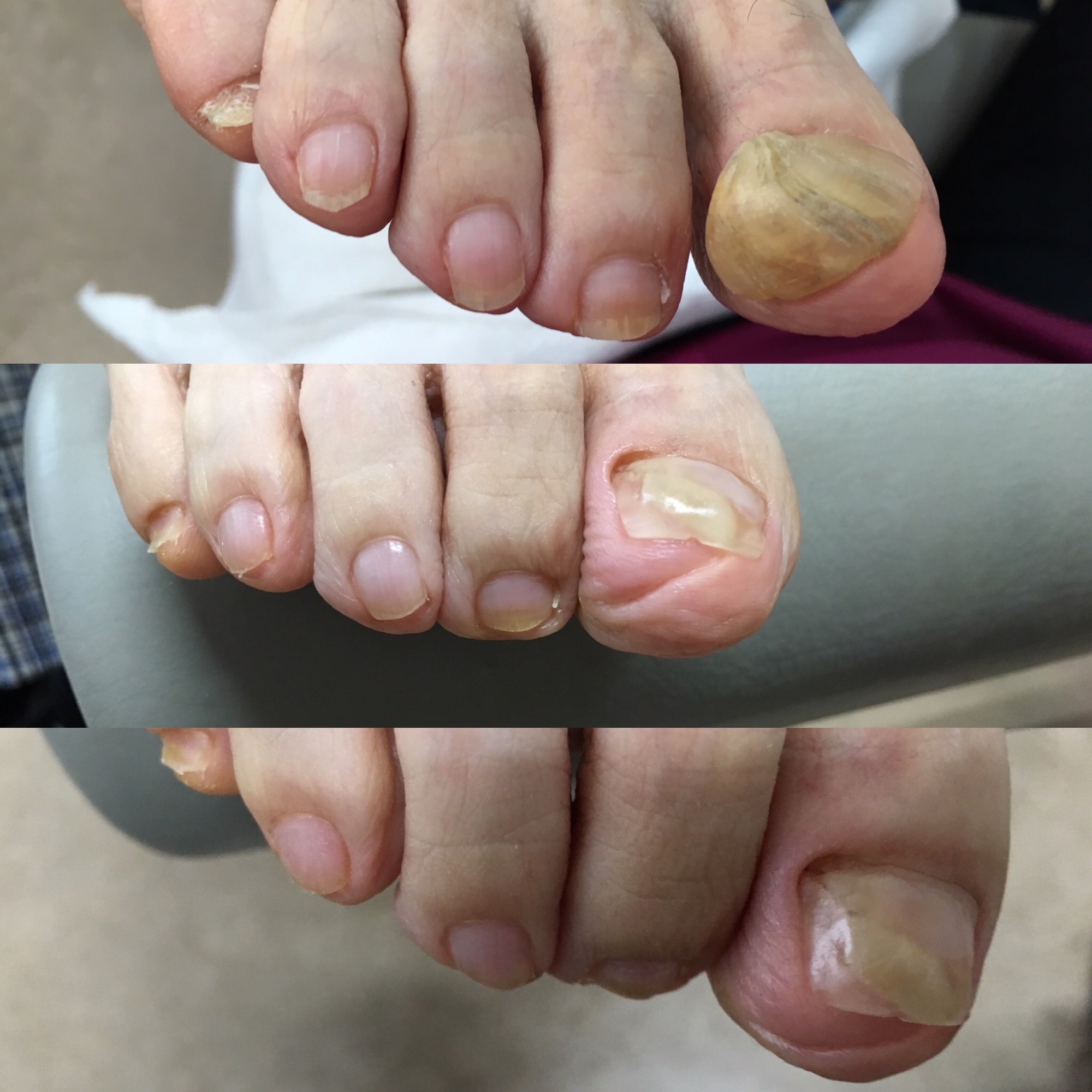 人工爪作製